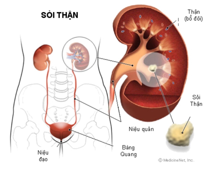 Nhận biết và ứng phó cơn đau quặn thận