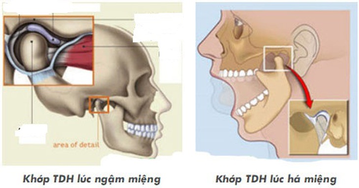 Rối loạn khớp thái dương hàm 