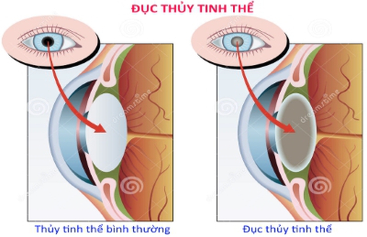 Phơi nhiễm lâu dài với tia UV có thể bị đục thủy tinh thể