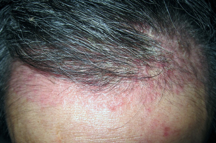 Trị rụng tóc do nấm, thuốc gì?