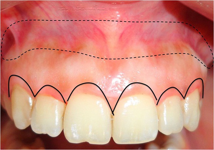  Khắc phục viêm lợi sau khi bọc răng sứ