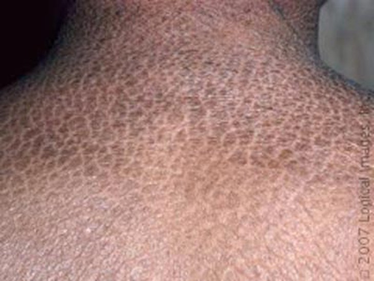 Bệnh da vẩy cá bẩm sinh có chữa khỏi được không?