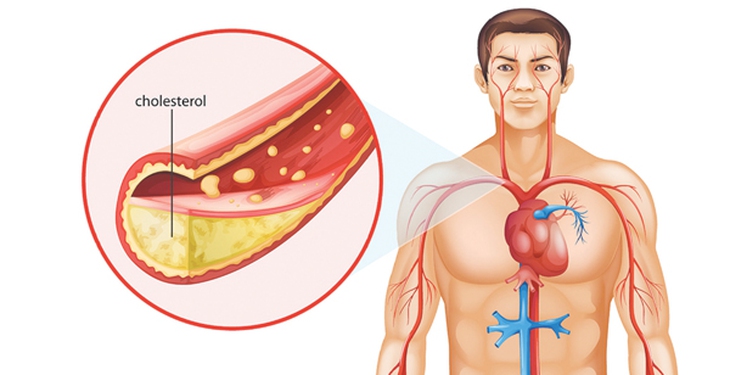 Khi nào dùng thuốc hạ lipid huyết?