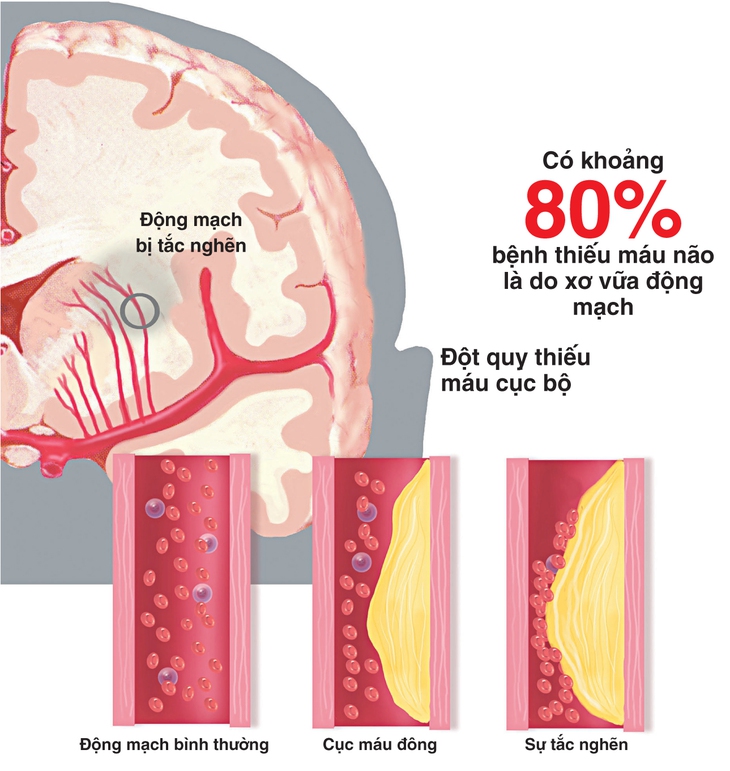 Thiểu năng tuần hoàn não có nguy hiểm không?
