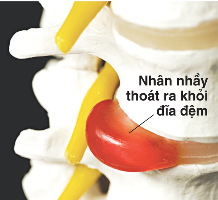 Điều trị và chăm sóc người thoát vị đĩa đệm cột sống thắt lưng