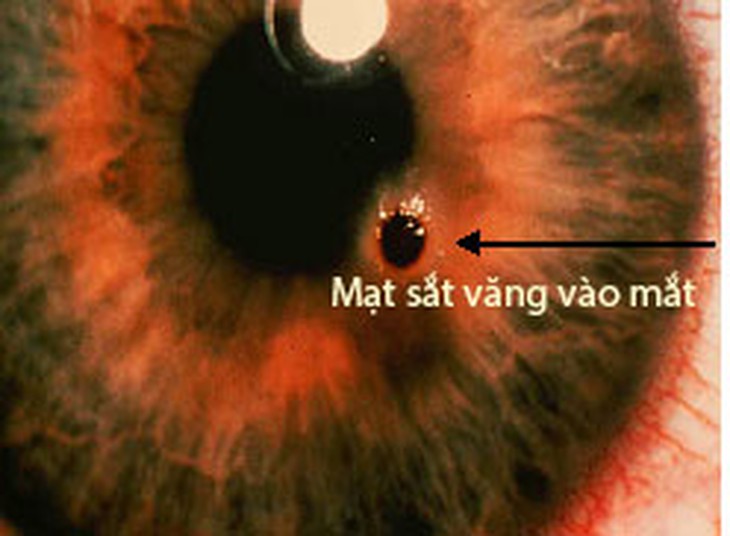Xử trí cấp cứu chấn thương mắt