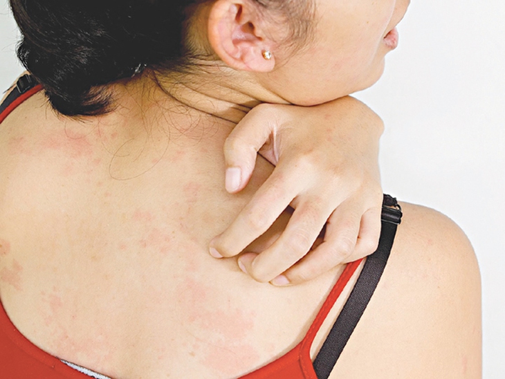 Dị ứng do vải vóc