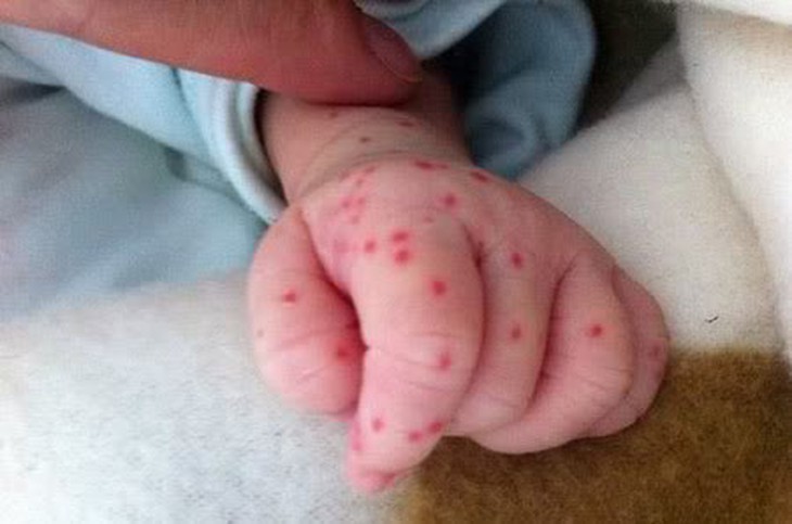Chứng xuất huyết giảm tiểu cầu