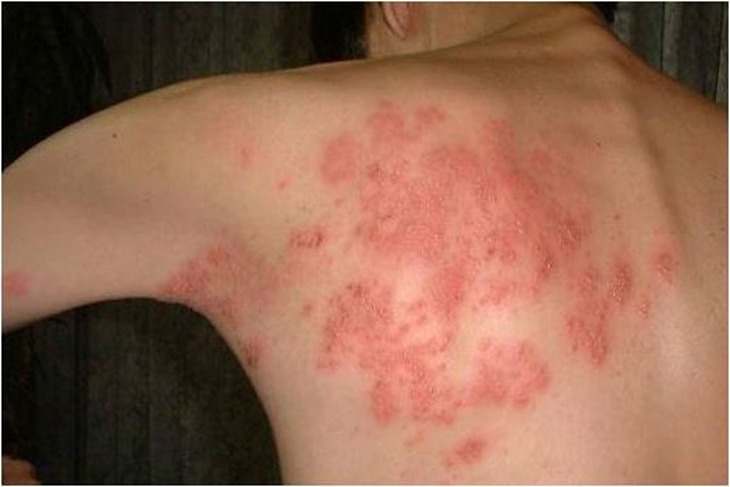 Viêm da dị ứng và cách trị