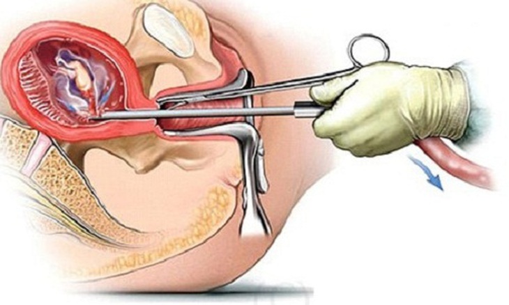 Có thai ngoài ý muốn ở trẻ vị thành niên