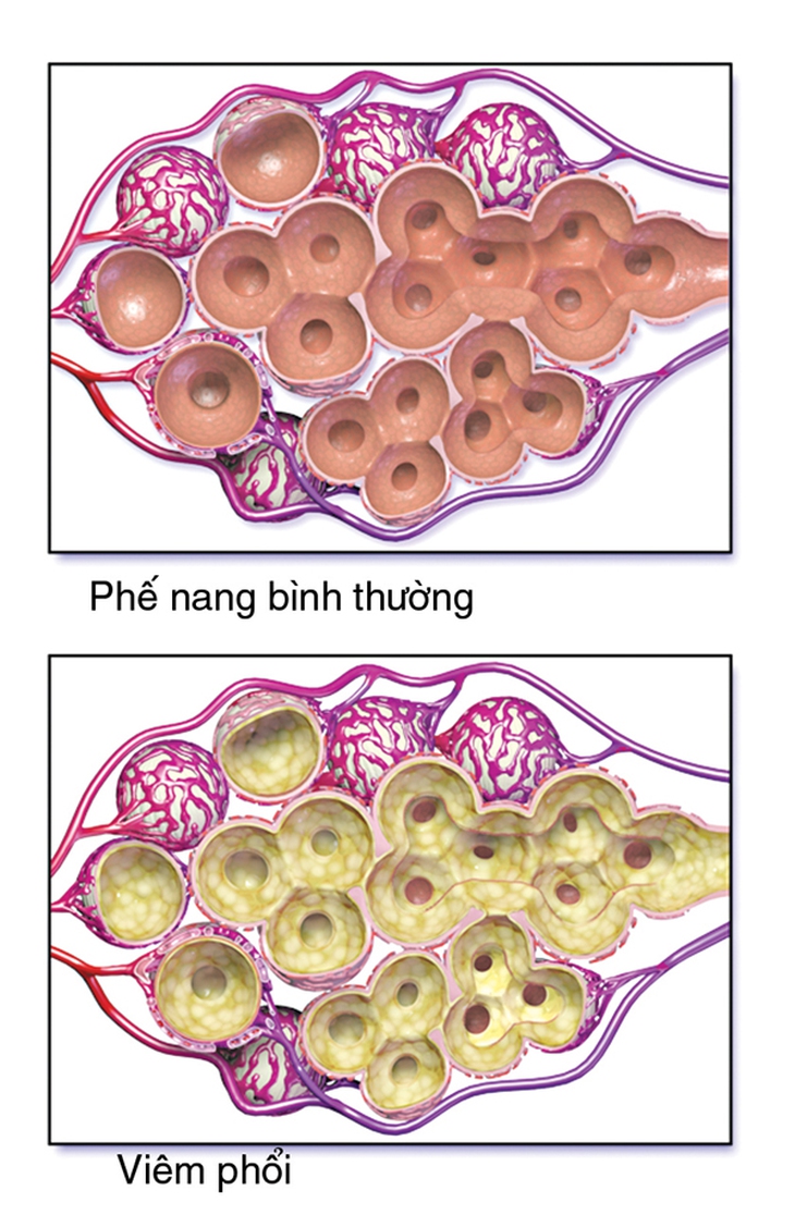 Phòng viêm phổi