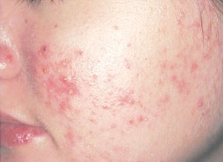 Nổi mụn vì dùng mỹ phẩm