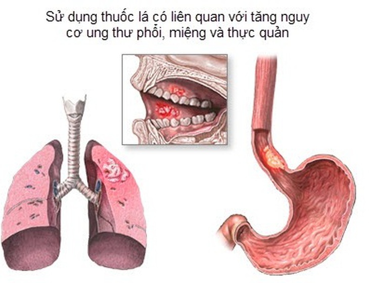 Nguy cơ ung thư khi sử dụng thuốc lá