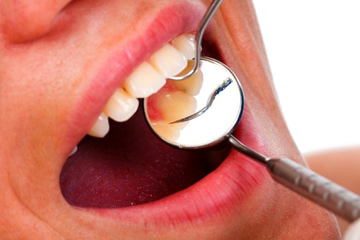 Thuốc nào điều trị viêm lợi?