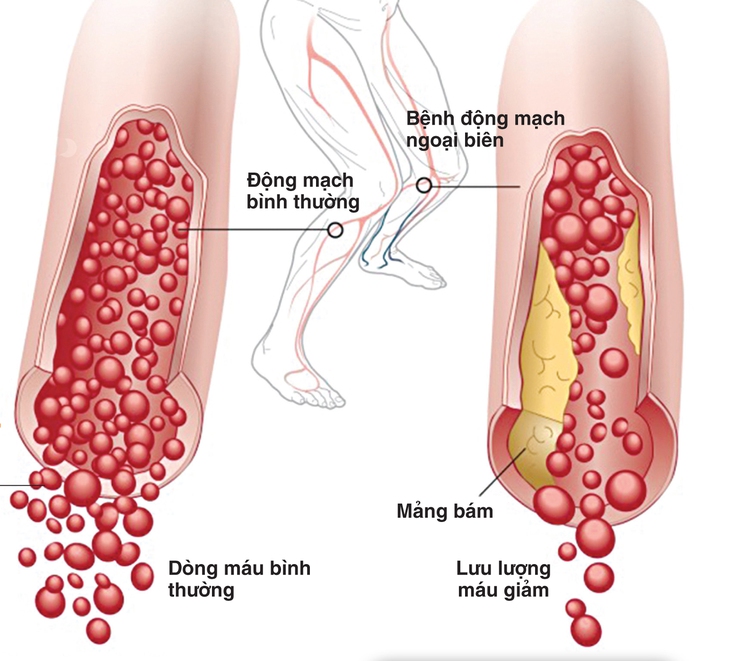 Bệnh động mạch ngoại biên của chi dưới
