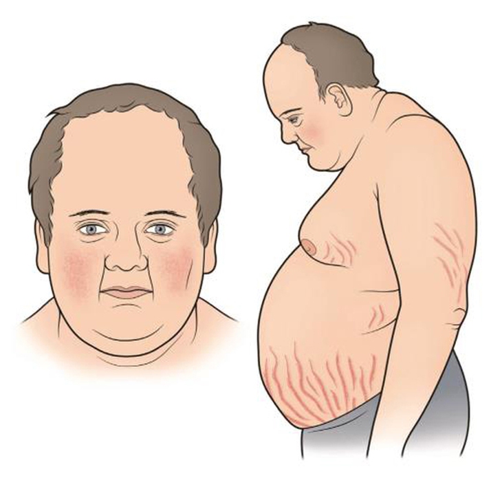 Bệnh nhi bị hội chứng Cushing hiếm gặp