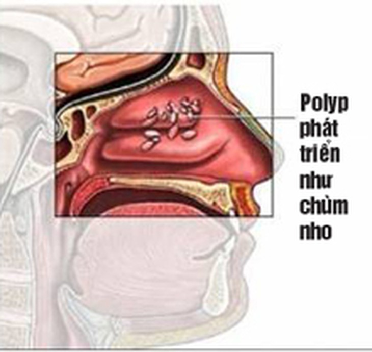 Khắc phục chứng nghẹt mũi khi chuyển mùa