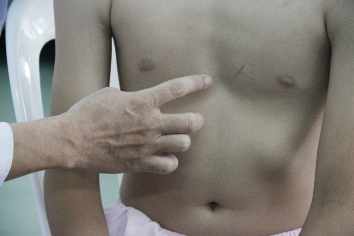Bệnh lõm ngực bẩm sinh và phương pháp điều trị