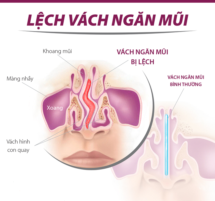 Khắc phục chứng nghẹt mũi khi chuyển mùa