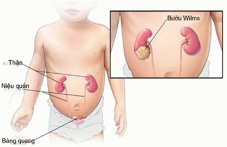 Bụng to ở trẻ