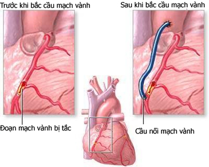 Những nguy cơ gặp phải khi bị cầu cơ động mạch vành