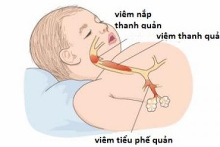 Điều trị viêm tiểu phế quản cho trẻ, thuốc nào?