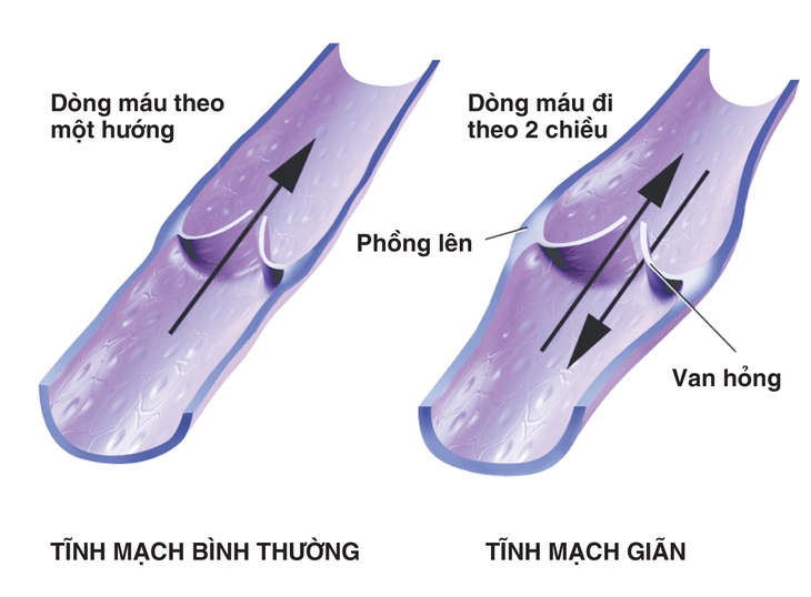 3 bệnh lý mạch máu nguy hiểm không thể bỏ sót
