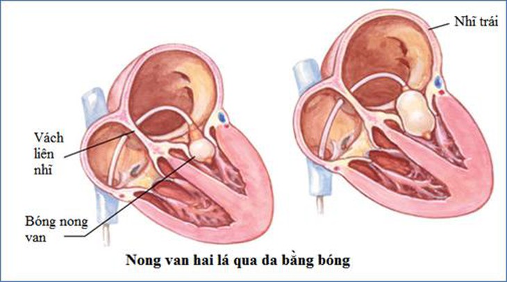 Bệnh van tim 