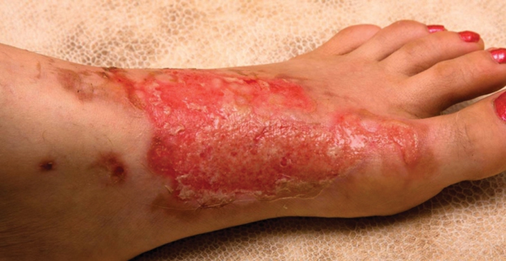 Xác định và xử trí điều trị bỏng