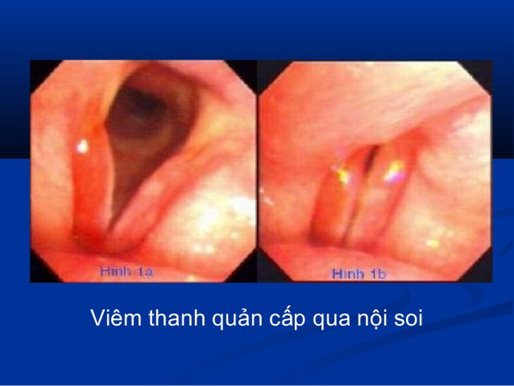 Cách phòng viêm thanh quản