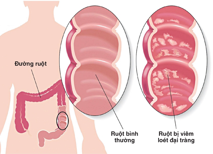 Nhận biết viêm loét đại trực tràng chảy máu