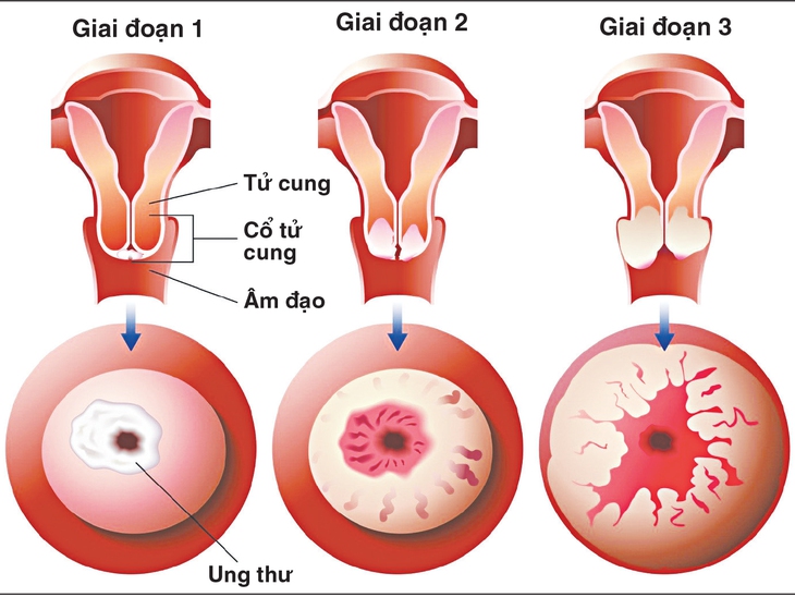 Xét nghiệm đọc tế bào 2 lần tầm soát ung thư cổ tử cung