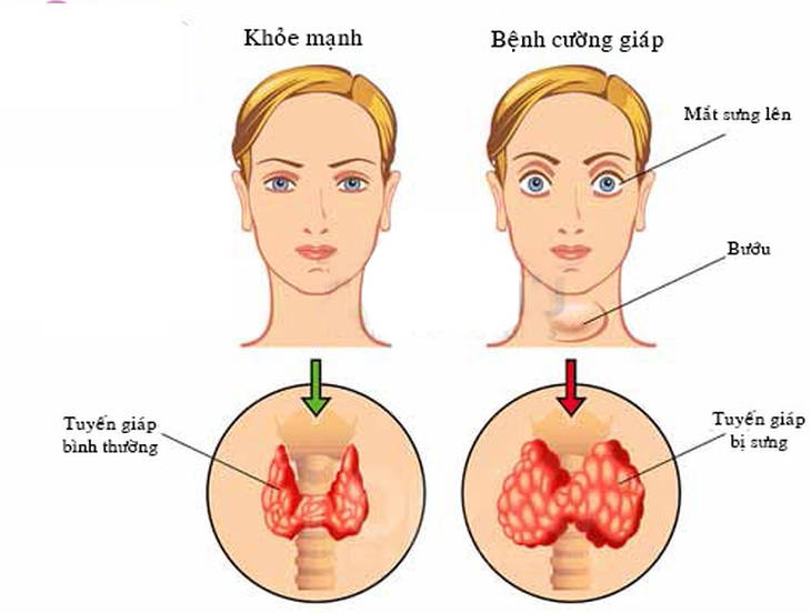 Bệnh cường giáp và các biến chứng tim mạch 