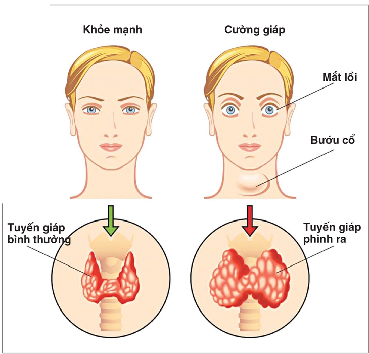 Bệnh bướu cổ và những điều cần biết
