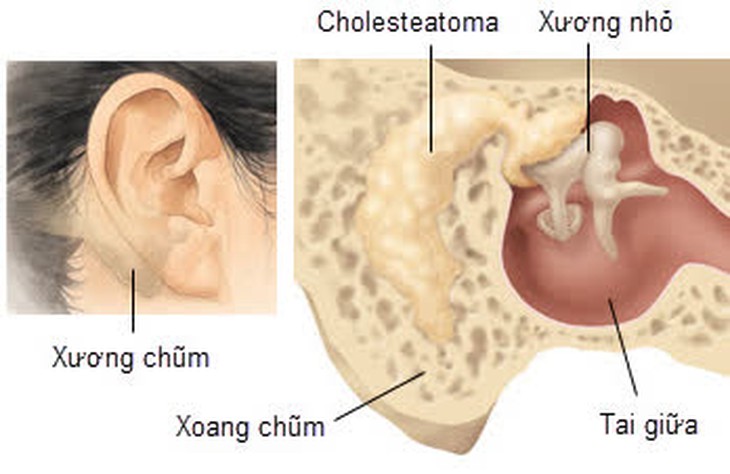 Viêm tai xương chũm cấp