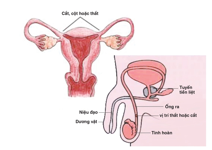 Triệt sản nam và triệt sản nữ