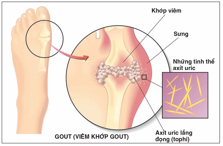 Bệnh gout ở người trẻ - chớ xem thường!