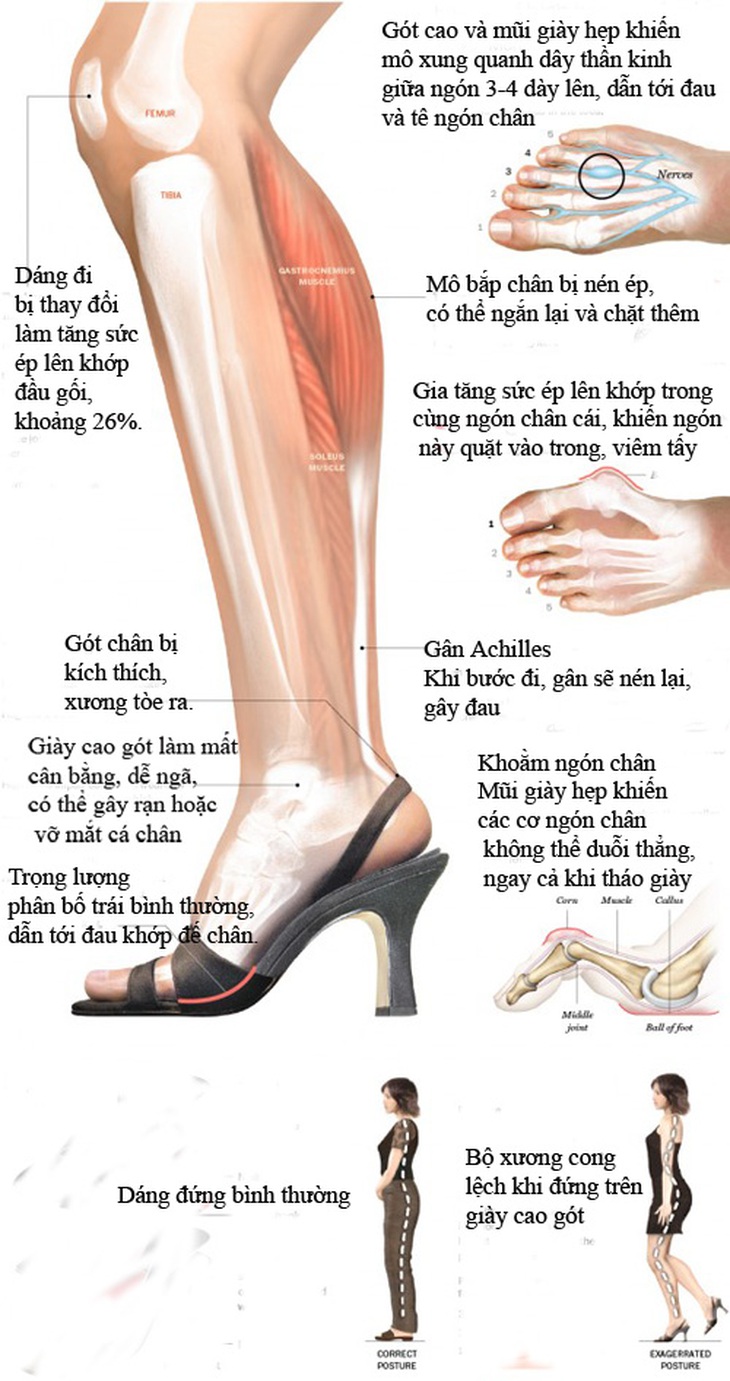 Cảnh báo nguy cơ do giày cao gót
