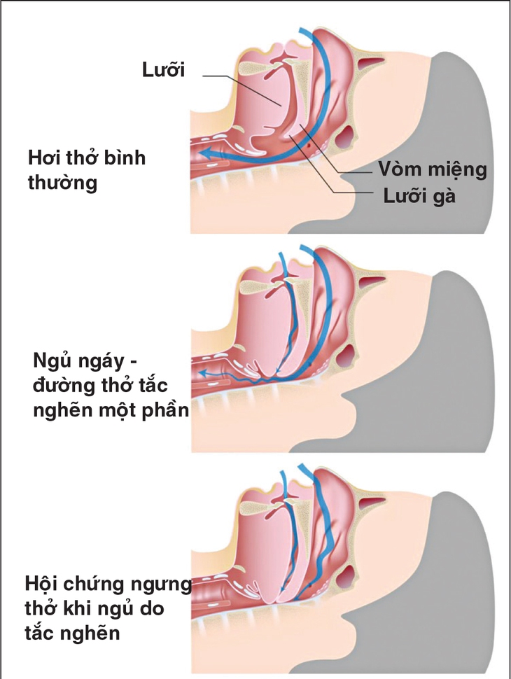 Ngưng thở khi ngủ do tắc nghẽn ngoại biên
