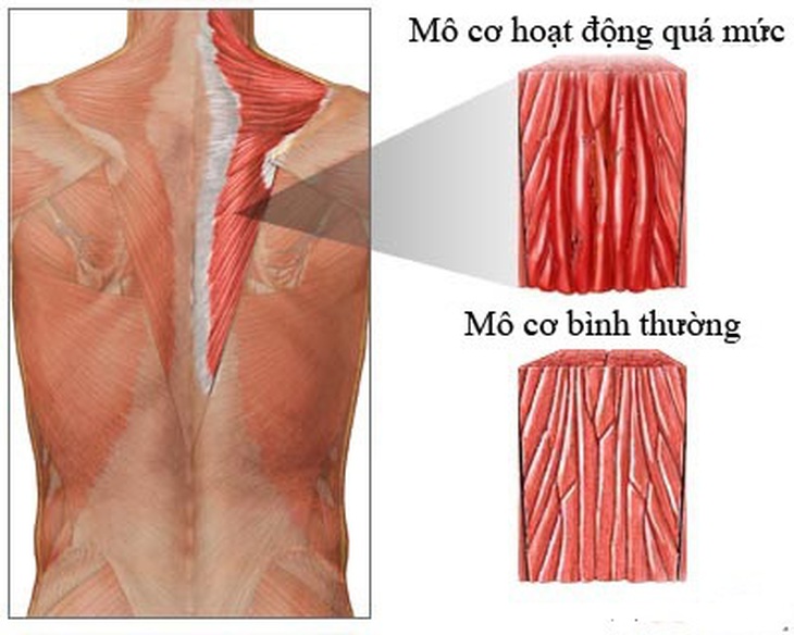 Bài thuốc trị chứng can hư dẫn đến thận âm hư