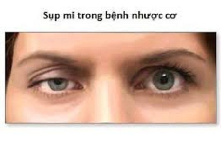 Bệnh nhược cơ có chữa được không?