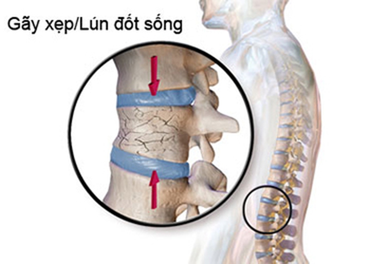 Loãng xương cần được phát hiện và điều trị sớm
