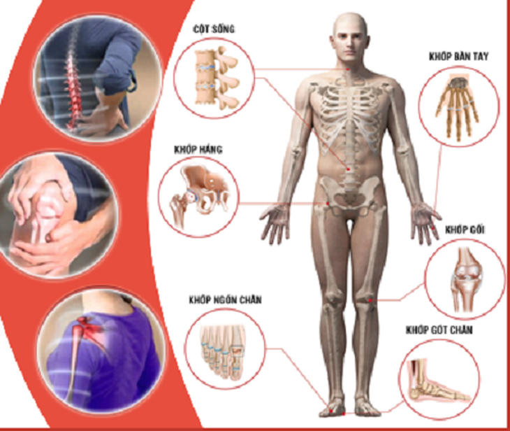 Bệnh cơ xương khớp 