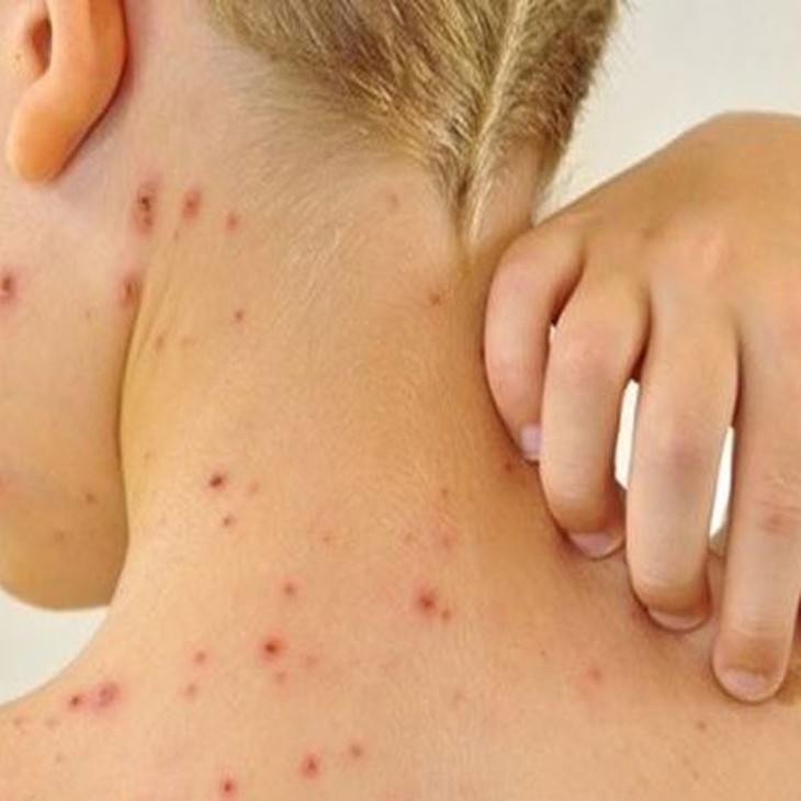 Phòng và trị một số bệnh ngoài da