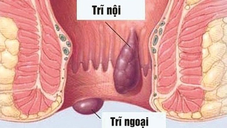 Nguyên nhân và cách xử trí khi đi ngoài ra máu