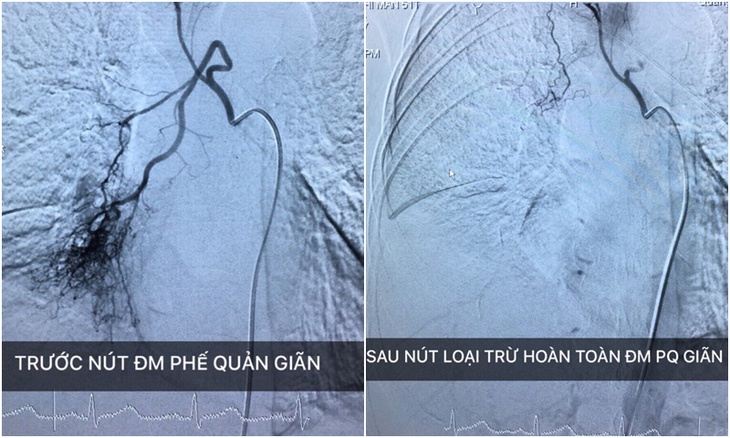 Quảng Ninh: Nút mạch phế quản thành công cho bệnh nhân ho ra máu 3 tuần