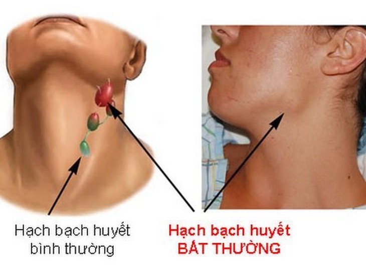 Ðau một bên họng