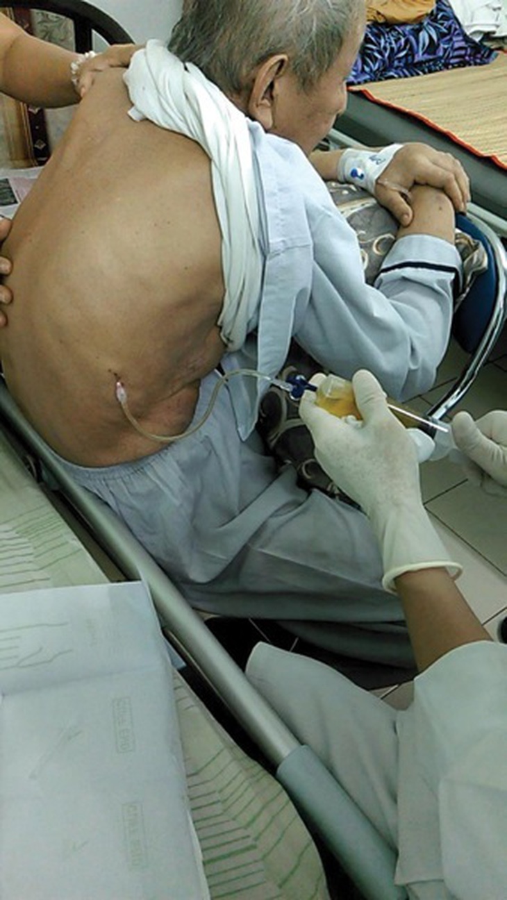 Tràn dịch màng phổi