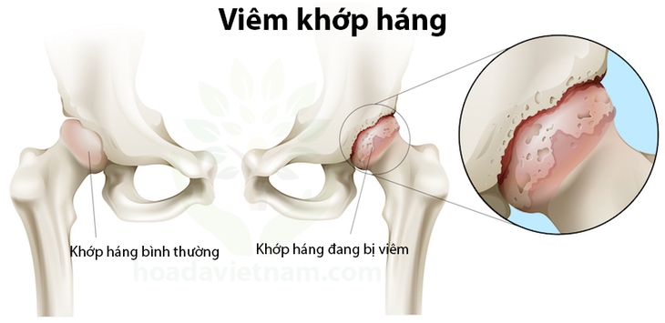 Cách trị đau khớp háng