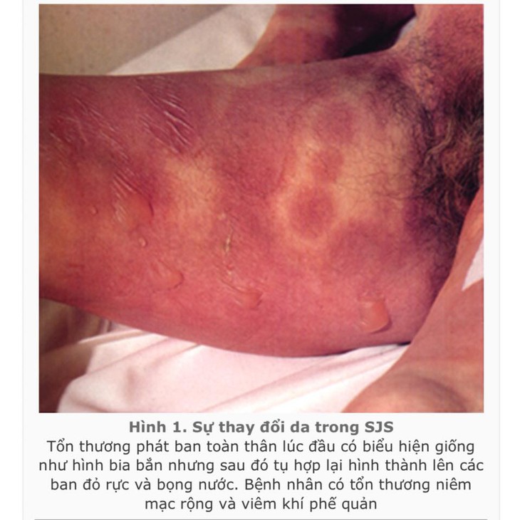 Cứu sống bệnh nhi bị hội chứng Stevens Johnson Syndrome do tự ý sử dụng thuốc